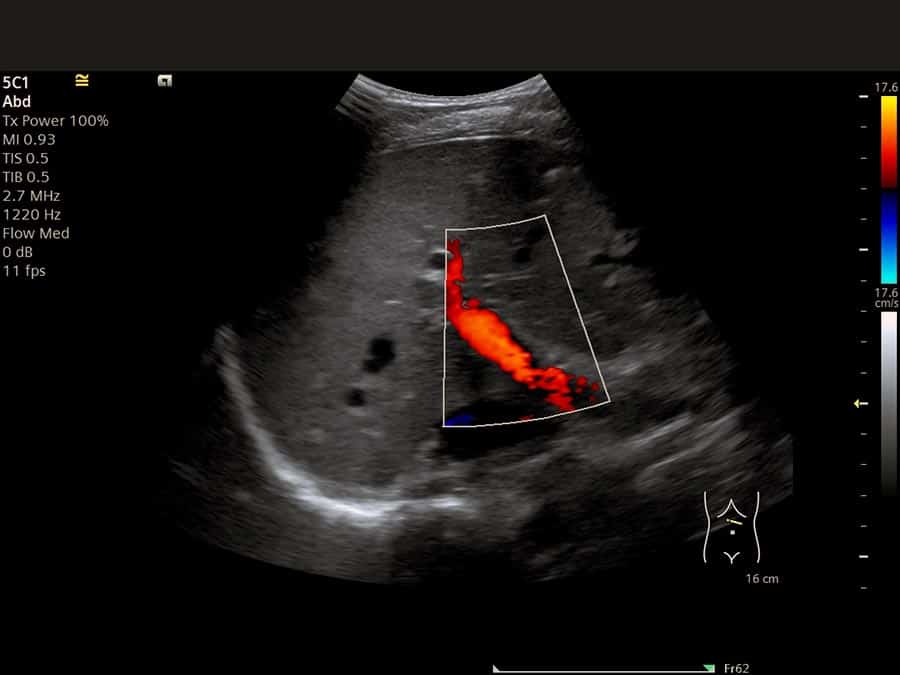 Abdominal Ultrasound Scan 