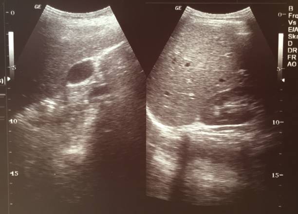 Liver & Gallbladder Ultrasound 